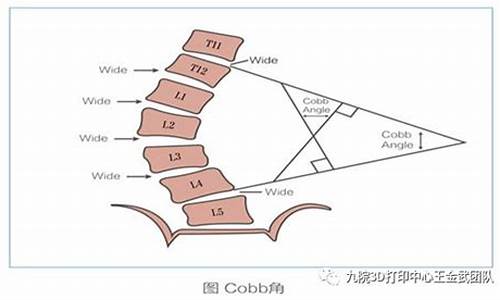 高考体检怎么查脊柱,高考体检查出脊柱侧弯会上报吗